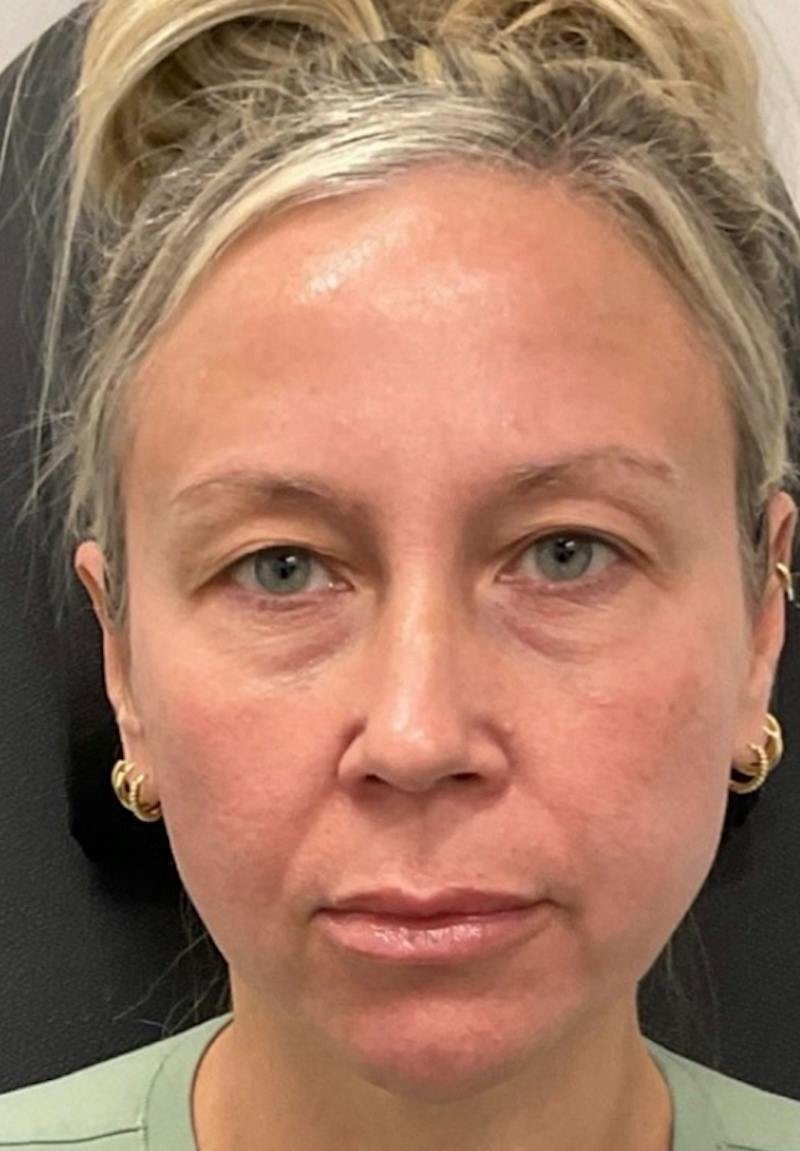 Results Before & After Gallery - Patient 452297 - Image 1