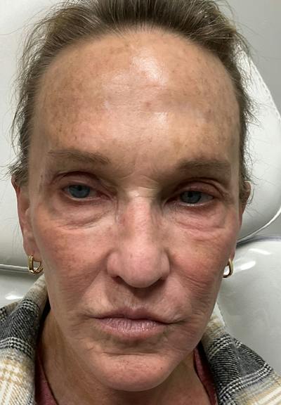 Results Before & After Gallery - Patient 877403 - Image 1
