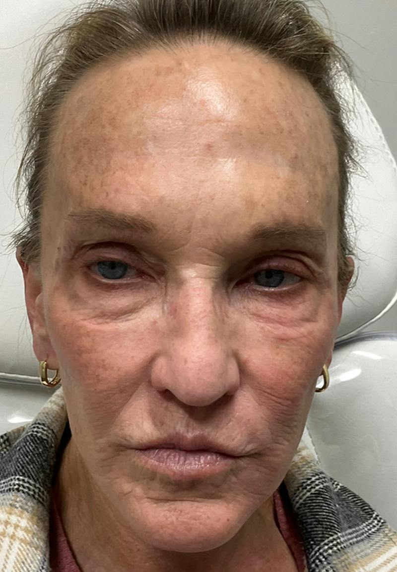 Results Before & After Gallery - Patient 877403 - Image 1