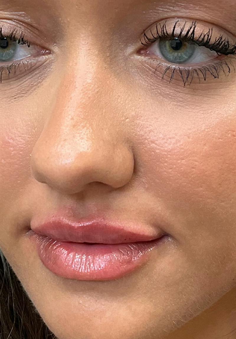 Results Before & After Gallery - Patient 595644 - Image 2
