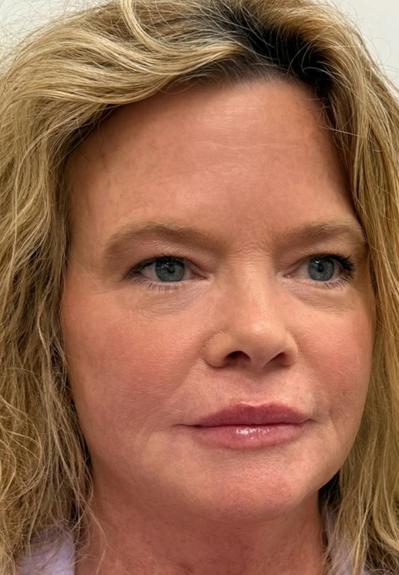Results Before & After Gallery - Patient 358975 - Image 2