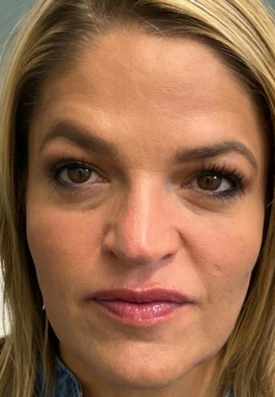 Results Before & After Gallery - Patient 184650 - Image 2