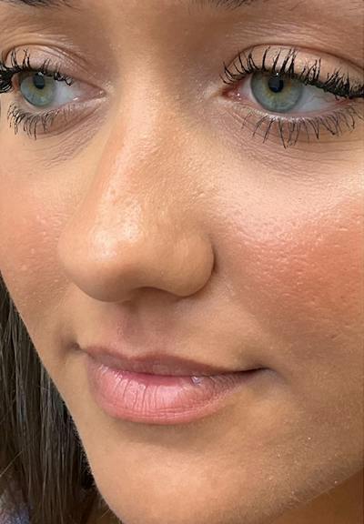 Results Before & After Gallery - Patient 595644 - Image 1