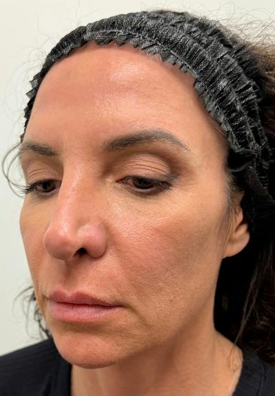 Results Before & After Gallery - Patient 123871 - Image 1