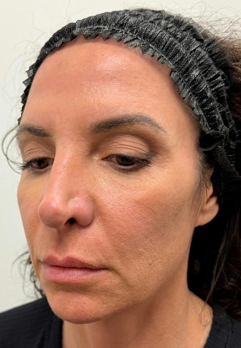Results Before & After Gallery - Patient 123871 - Image 1
