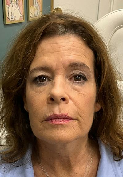 Results Before & After Gallery - Patient 150897 - Image 1