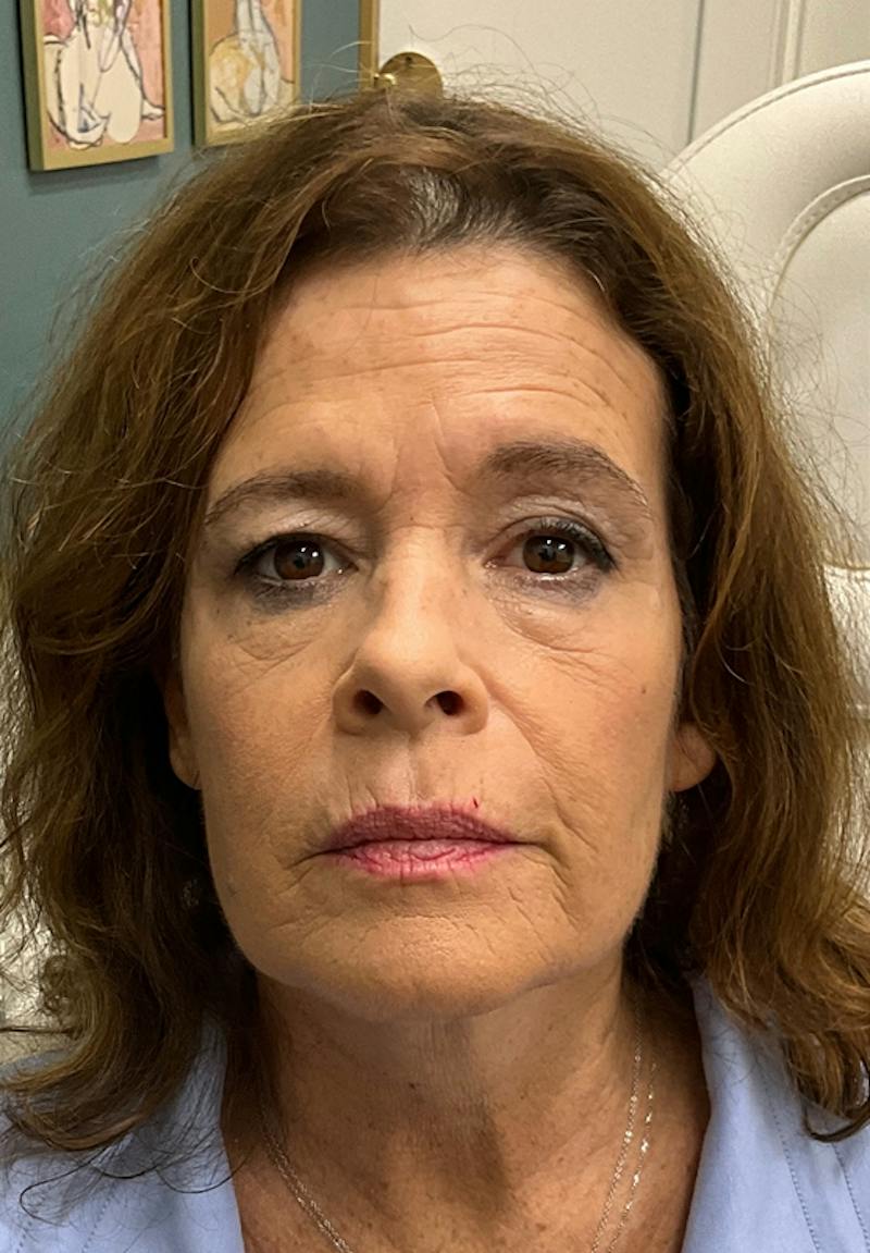 Results Before & After Gallery - Patient 150897 - Image 1