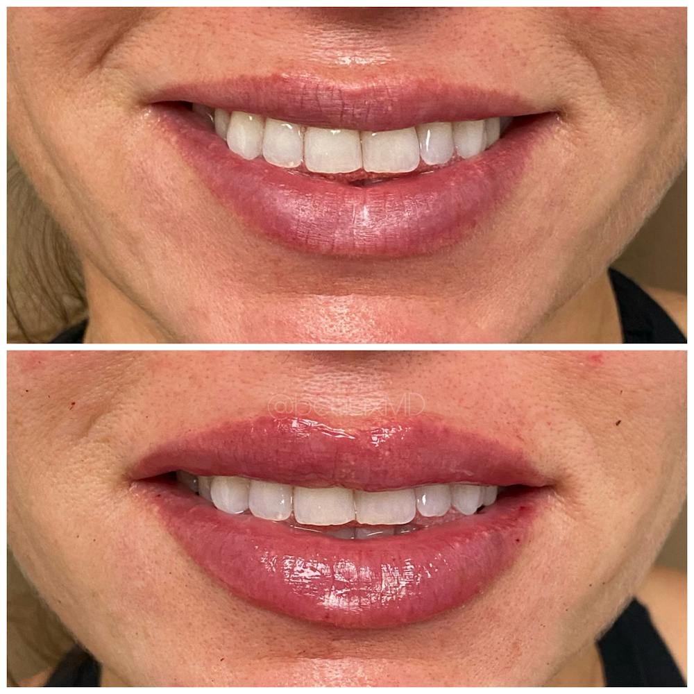 Dermal Fillers Before & After Gallery - Patient 123700470 - Image 1