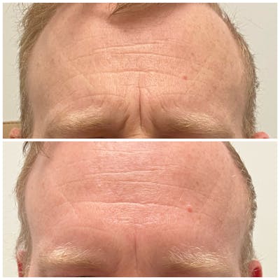 Botox & Dysport Before & After Gallery - Patient 123700474 - Image 2