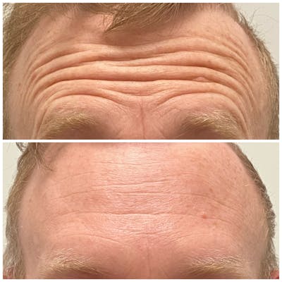 Botox & Dysport Before & After Gallery - Patient 123700474 - Image 1