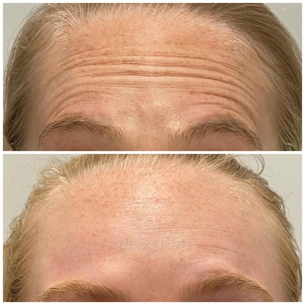 Botox & Dysport Before & After Gallery - Patient 123700476 - Image 1