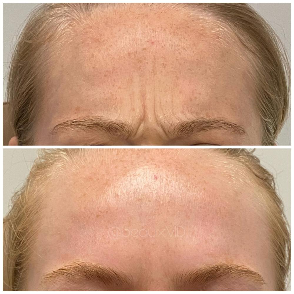Botox & Dysport Before & After Gallery - Patient 123700476 - Image 2