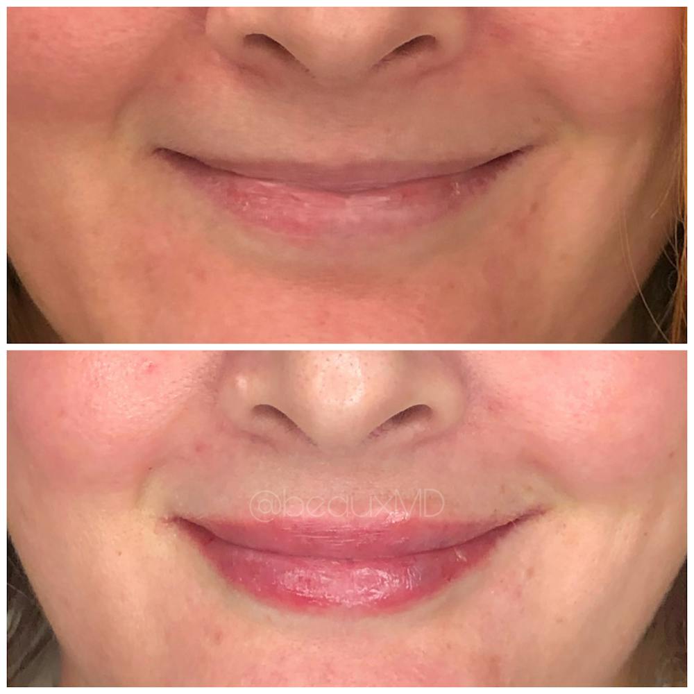 Dermal Fillers Before & After Gallery - Patient 123700478 - Image 1