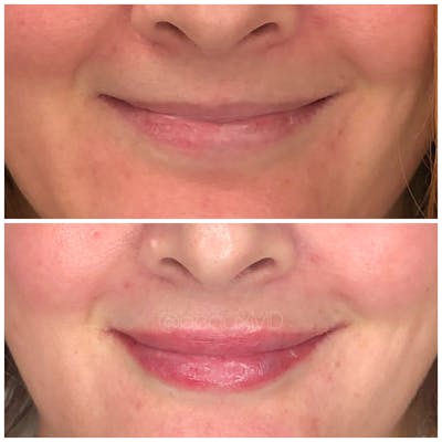 Dermal Fillers Before & After Gallery - Patient 123700478 - Image 1