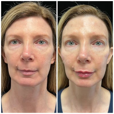 Dermal Fillers Before & After Gallery - Patient 123700479 - Image 1