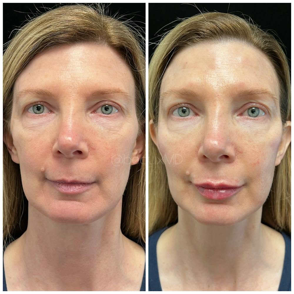 Dermal Fillers Before & After Gallery - Patient 123700479 - Image 1