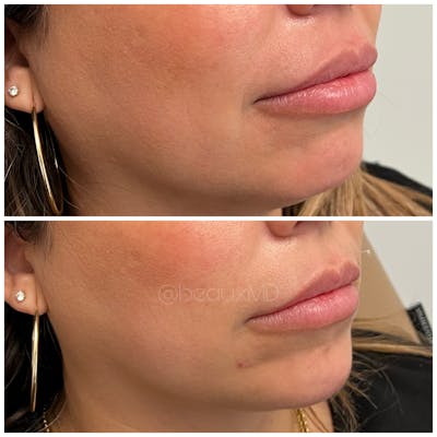 Dermal Fillers Before & After Gallery - Patient 123700481 - Image 1