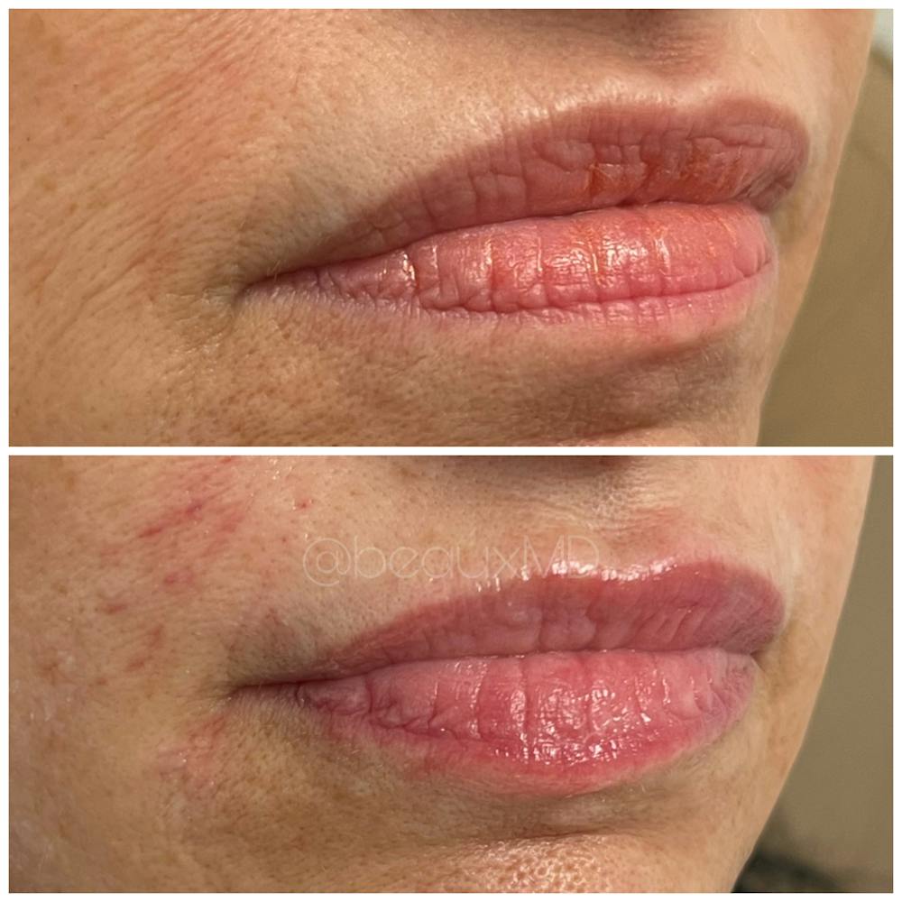 Dermal Fillers Before & After Gallery - Patient 123700482 - Image 1