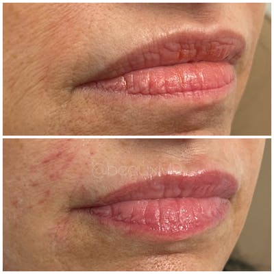 Dermal Fillers Before & After Gallery - Patient 123700482 - Image 1