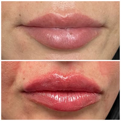 Dermal Fillers Before & After Gallery - Patient 123700486 - Image 1
