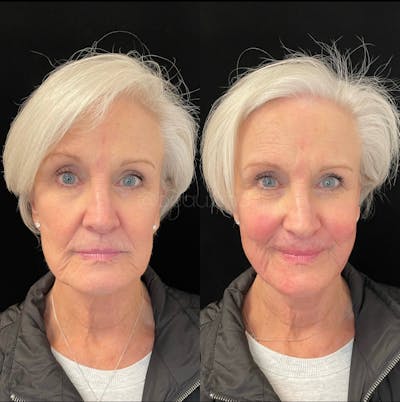 Thread Lift Before & After Gallery - Patient 123700488 - Image 1