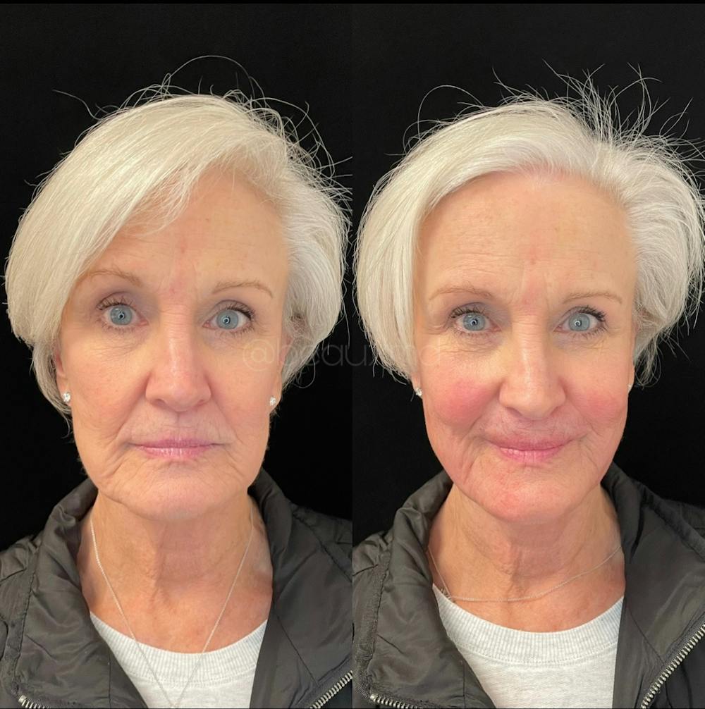 Thread Lift Before & After Gallery - Patient 123700488 - Image 1