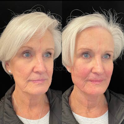 Thread Lift Before & After Gallery - Patient 123700488 - Image 2