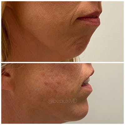 Dermal Fillers Before & After Gallery - Patient 123700489 - Image 1
