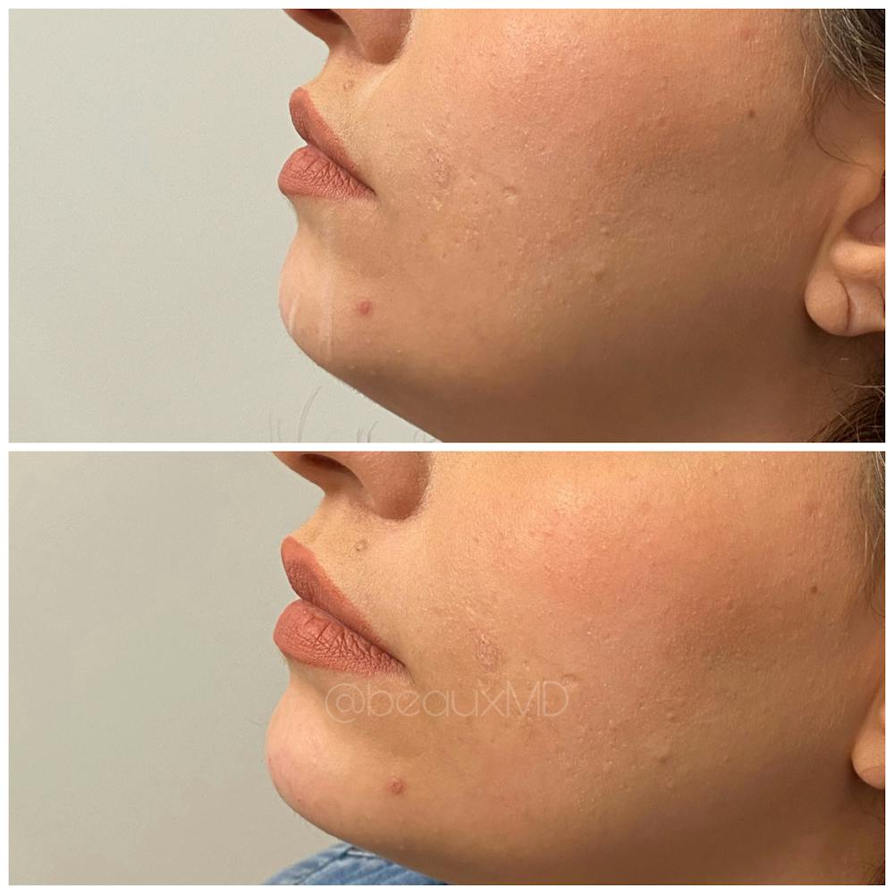 Dermal Fillers Before & After Gallery - Patient 123700491 - Image 1