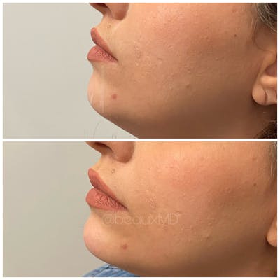 Dermal Fillers Before & After Gallery - Patient 123700491 - Image 1