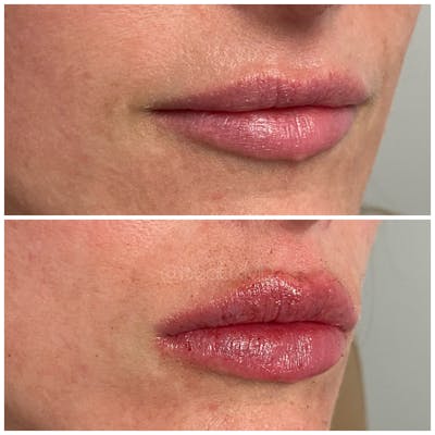 Dermal Fillers Before & After Gallery - Patient 123700492 - Image 1