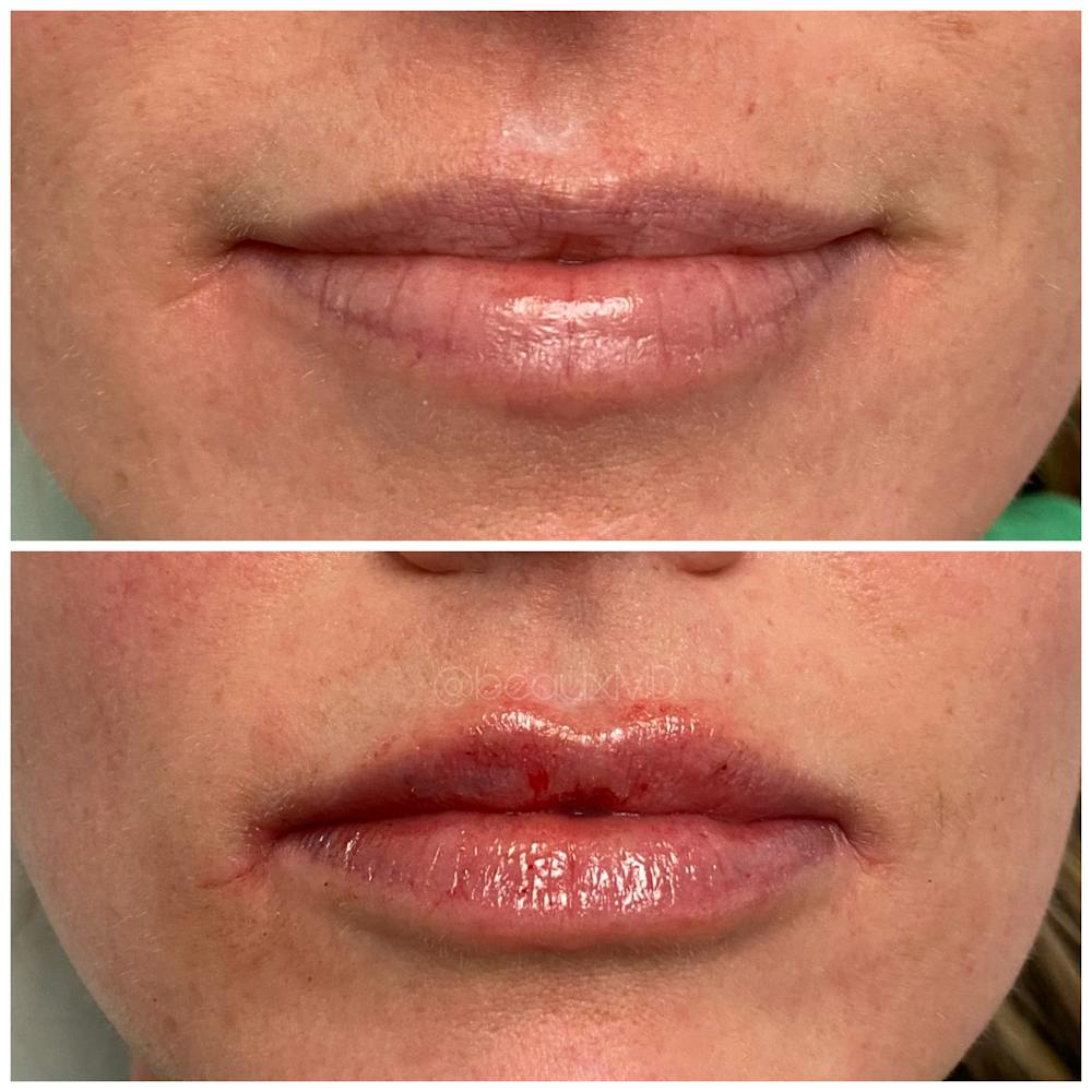 Dermal Fillers Before & After Gallery - Patient 123700493 - Image 1
