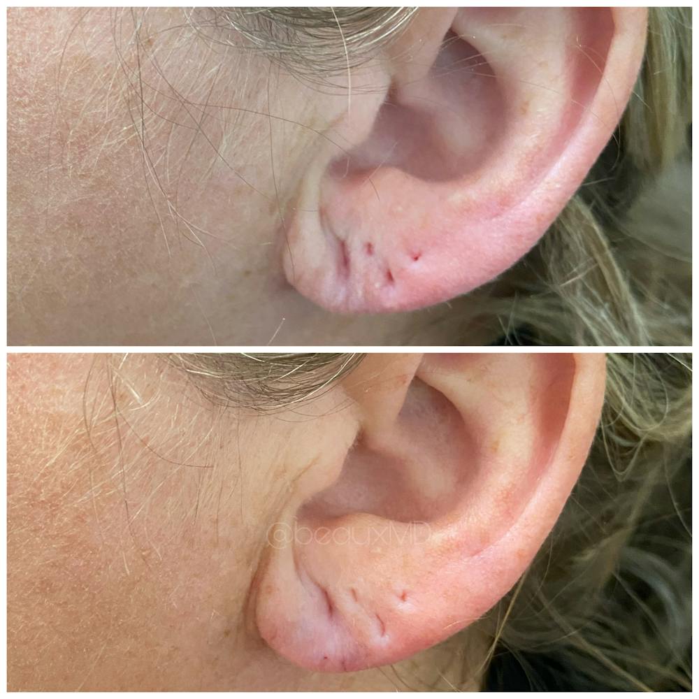 Dermal Fillers Before & After Gallery - Patient 123700495 - Image 1