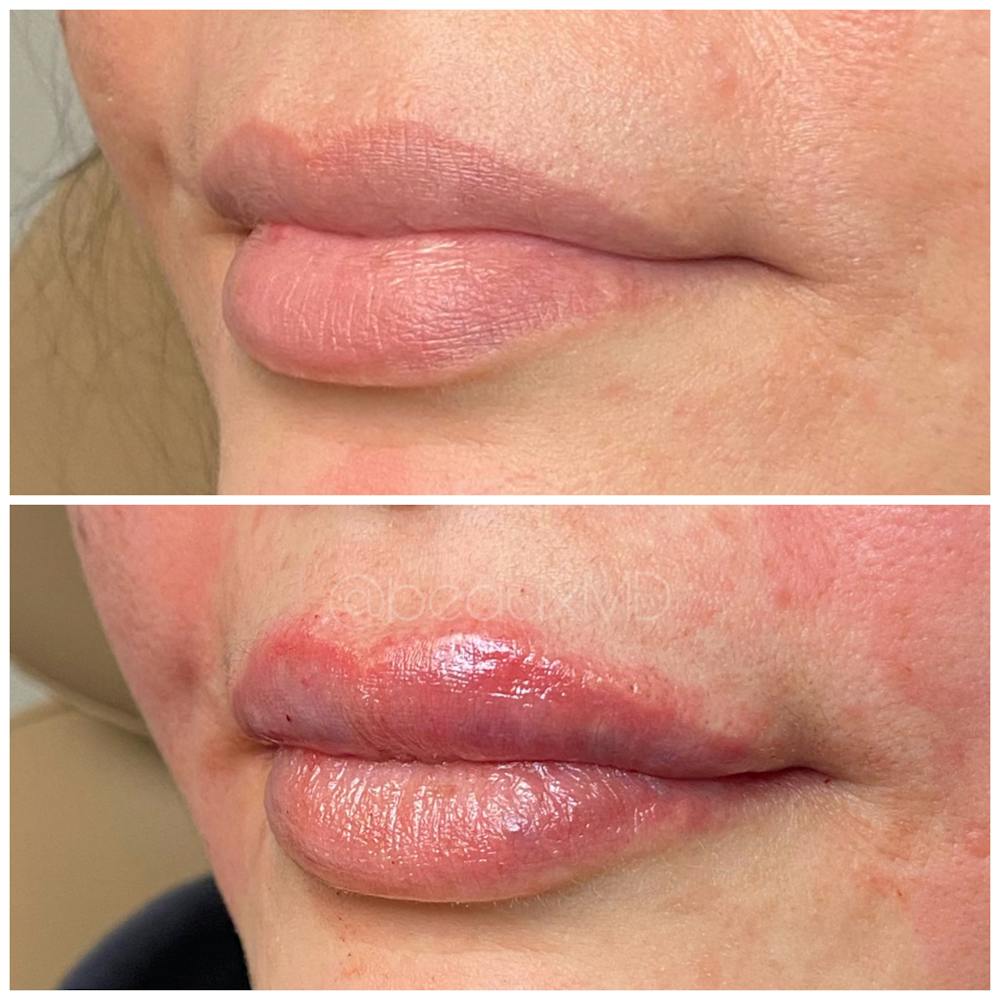 Dermal Fillers Before & After Gallery - Patient 123700497 - Image 1