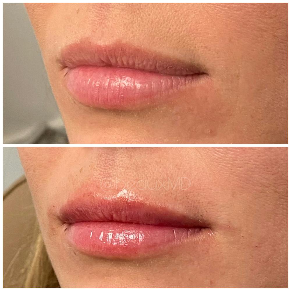 Dermal Fillers Before & After Gallery - Patient 123700498 - Image 1