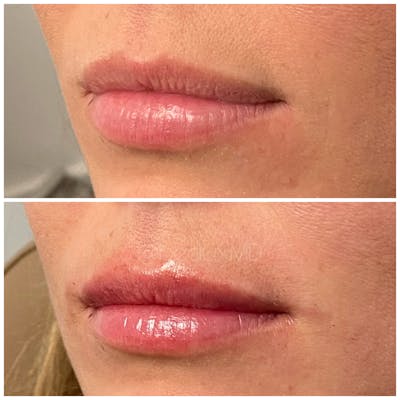 Dermal Fillers Before & After Gallery - Patient 123700498 - Image 1
