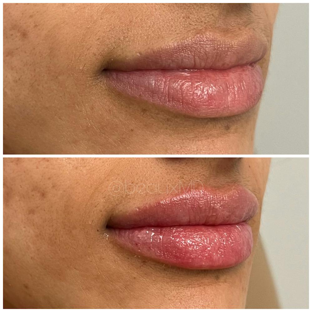 Dermal Fillers Before & After Gallery - Patient 123700500 - Image 1