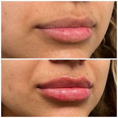 Dermal Fillers Before & After Gallery - Patient 123700501 - Image 1