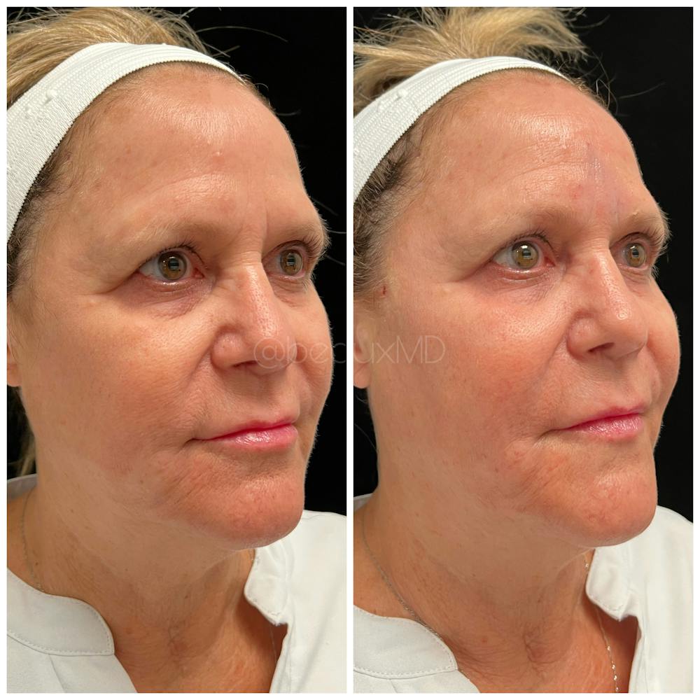 Thread Lift Before & After Gallery - Patient 123700503 - Image 1