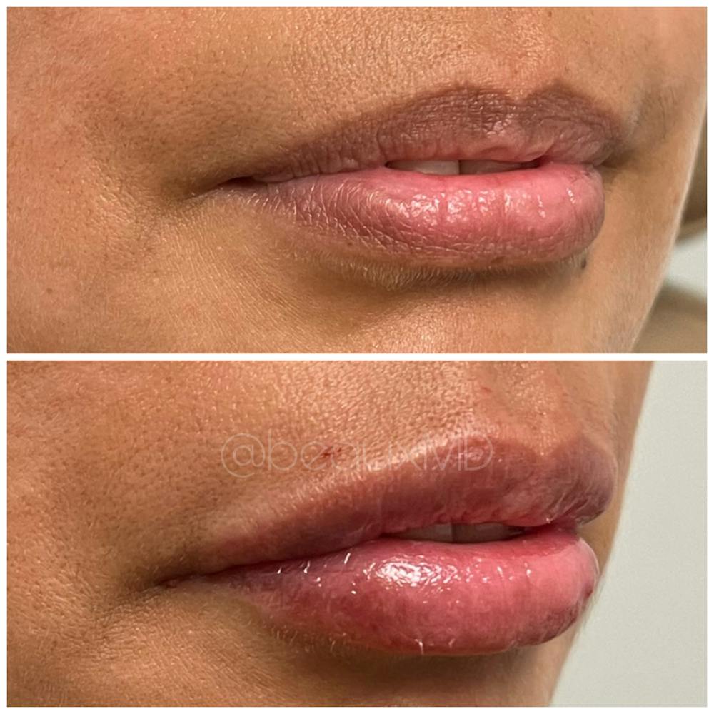 Dermal Fillers Before & After Gallery - Patient 123700505 - Image 1