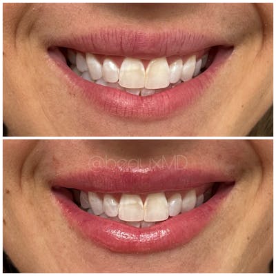 Dermal Fillers Before & After Gallery - Patient 123700507 - Image 1