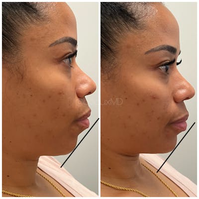 Dermal Fillers Before & After Gallery - Patient 123700508 - Image 1