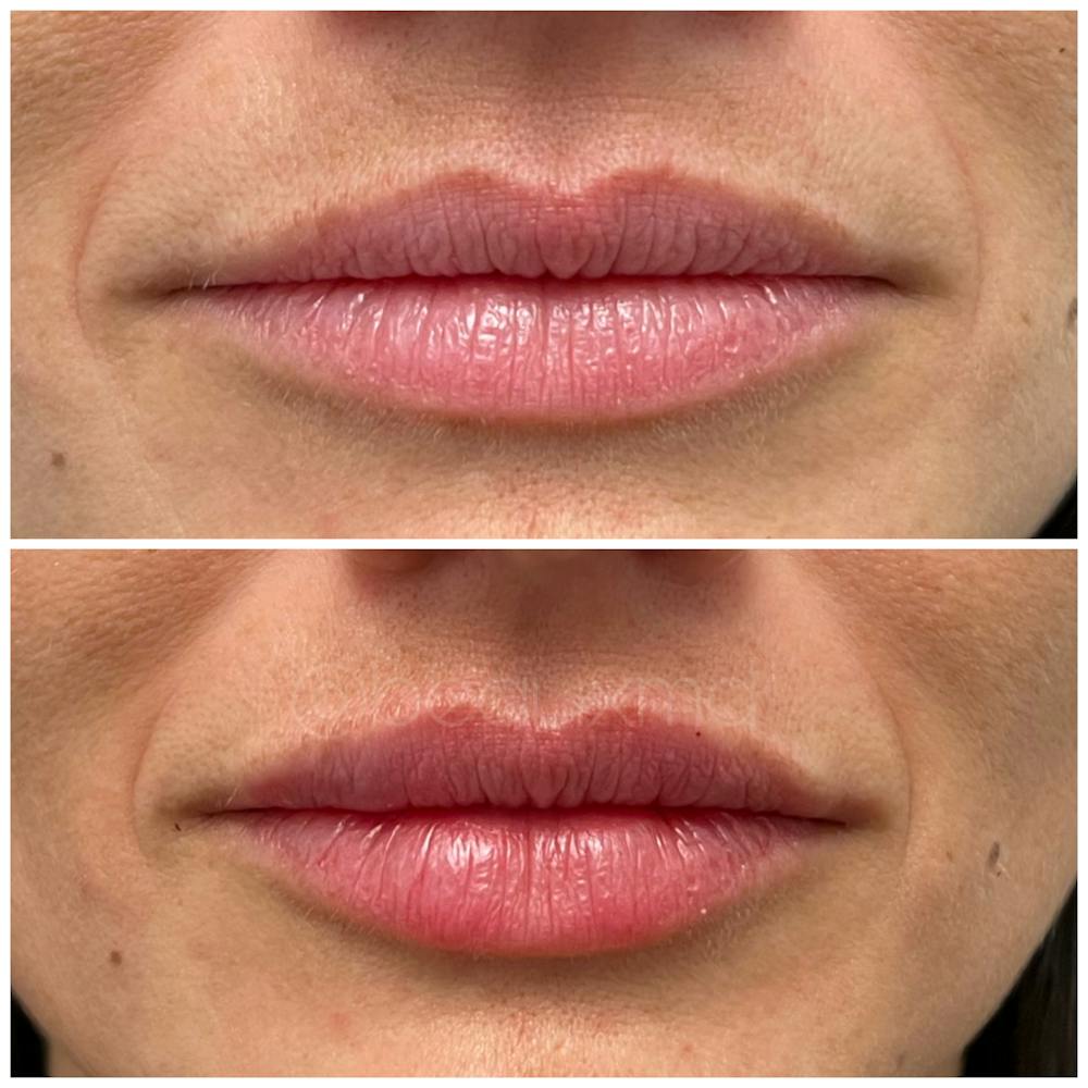 Dermal Fillers Before & After Gallery - Patient 123700509 - Image 1