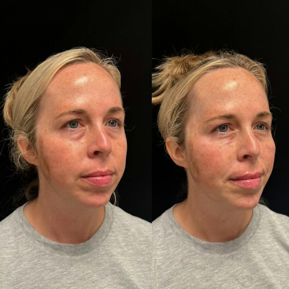 Dermal Fillers Before & After Gallery - Patient 453507 - Image 2
