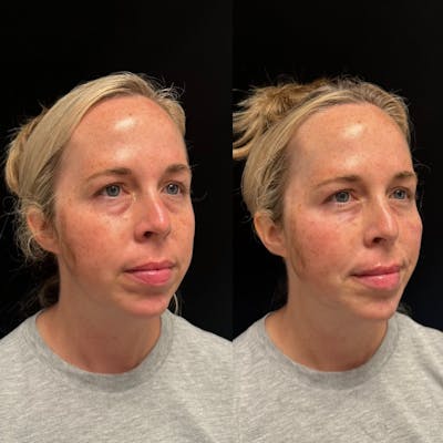 Dermal Fillers Before & After Gallery - Patient 453507 - Image 2