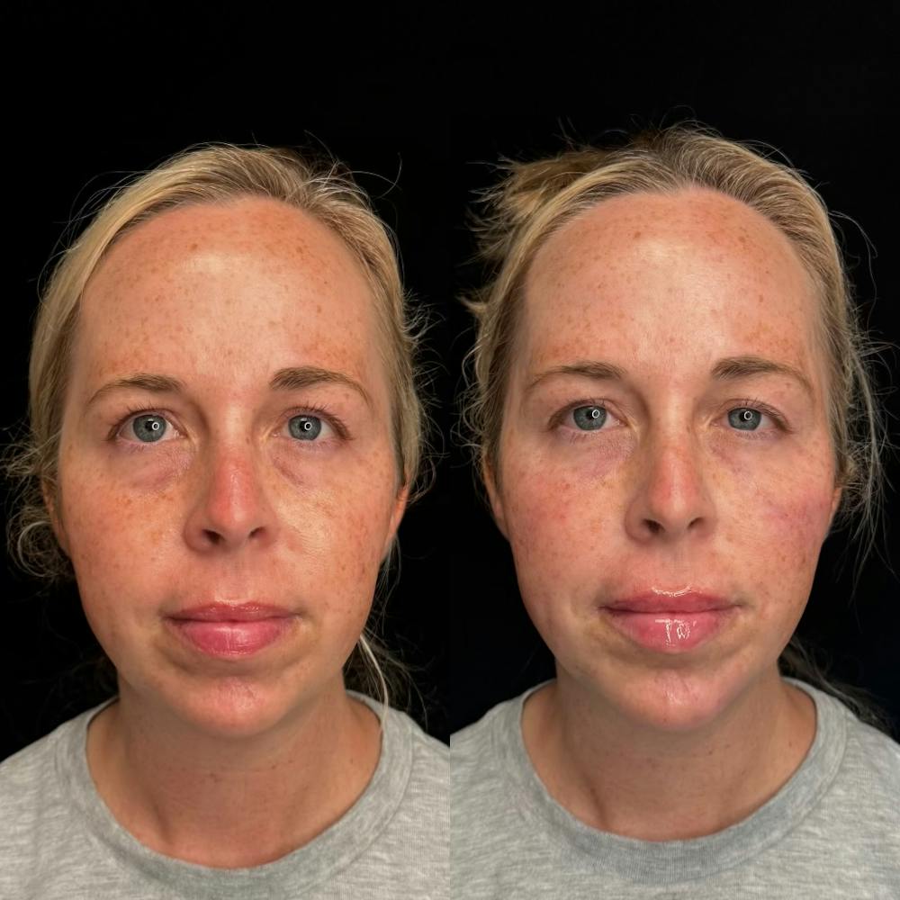 Dermal Fillers Before & After Gallery - Patient 453507 - Image 1