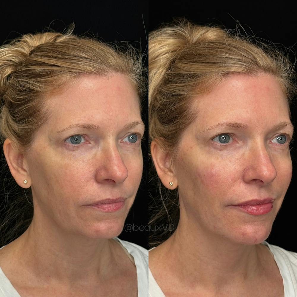 Dermal Fillers Before & After Gallery - Patient 223390 - Image 1