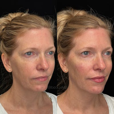 Dermal Fillers Before & After Gallery - Patient 223390 - Image 1