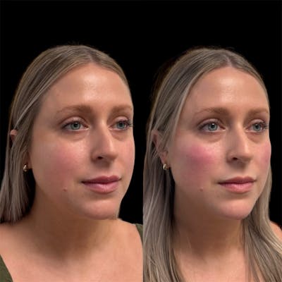 Dermal Fillers Before & After Gallery - Patient 342745 - Image 1