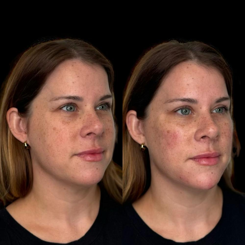 Dermal Fillers Before & After Gallery - Patient 405214 - Image 1